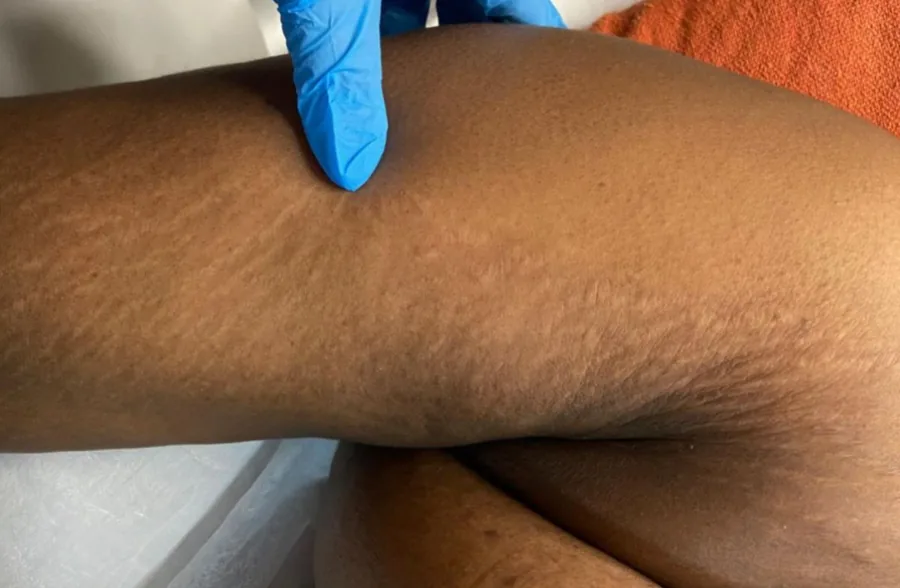 Flancos antes e depois do tratamento de estrias com MicroPercut — depois